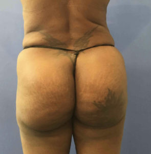 Fat Transfer to Buttocks Before and After Pictures Washington, DC