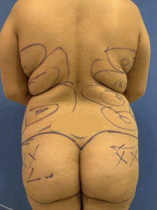 Fat Transfer to Buttocks Before and After Pictures Washington, DC