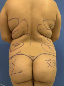 Fat Transfer to Buttocks Before and After Pictures Washington, DC