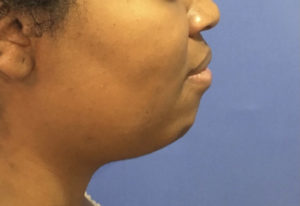 Chin Implants Before and After Pictures Washington, DC