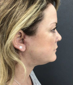Facelift Before and After Pictures Washington, DC