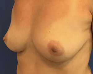 Breast Augmentation Before and After Pictures Washington, DC