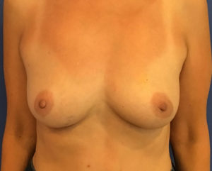 Breast Augmentation Before and After Pictures Washington, DC