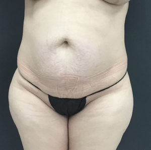 Tummy Tuck Before and After Pictures Washington, DC