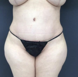 Tummy Tuck Before and After Pictures Washington, DC