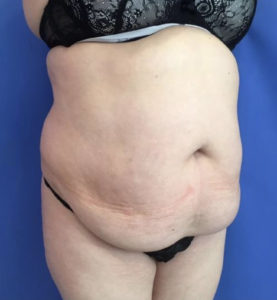 Tummy Tuck Before and After Pictures Washington, DC