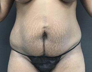 Tummy Tuck Before and After Pictures Washington, DC