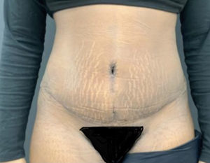 Tummy Tuck Before and After Pictures Washington, DC