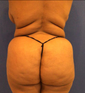 Fat Transfer to Buttocks Before and After Pictures Washington, DC