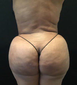 Fat Transfer to Buttocks Before and After Pictures Washington, DC