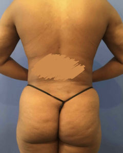 Fat Transfer to Buttocks Before and After Pictures Washington, DC