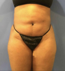 Liposuction Before and After Pictures Washington, DC