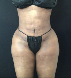 Liposuction Before and After Pictures Washington, DC