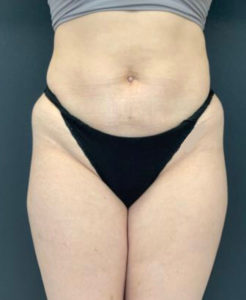 Liposuction Before and After Pictures Washington, DC