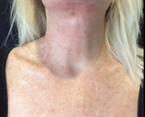 IPL Laser Before and After Pictures in Washington, DC