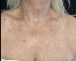 IPL Laser Before and After Pictures in Washington, DC