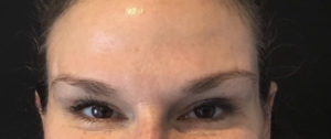 Fillers and Injectables Before and After Pictures Washington, DC