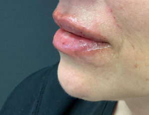 Fillers and Injectables Before and After Pictures Washington, DC