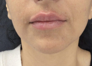 Fillers and Injectables Before and After Pictures Washington, DC