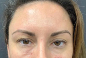 Fillers and Injectables Before and After Pictures Washington, DC