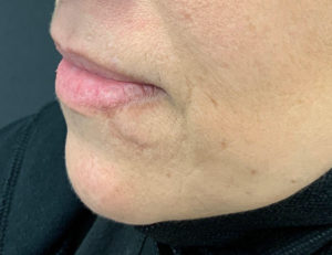Fillers and Injectables Before and After Pictures Washington, DC