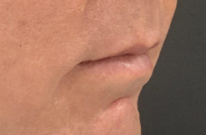 Fillers and Injectables Before and After Pictures Washington, DC