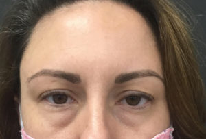 Fillers and Injectables Before and After Pictures Washington, DC