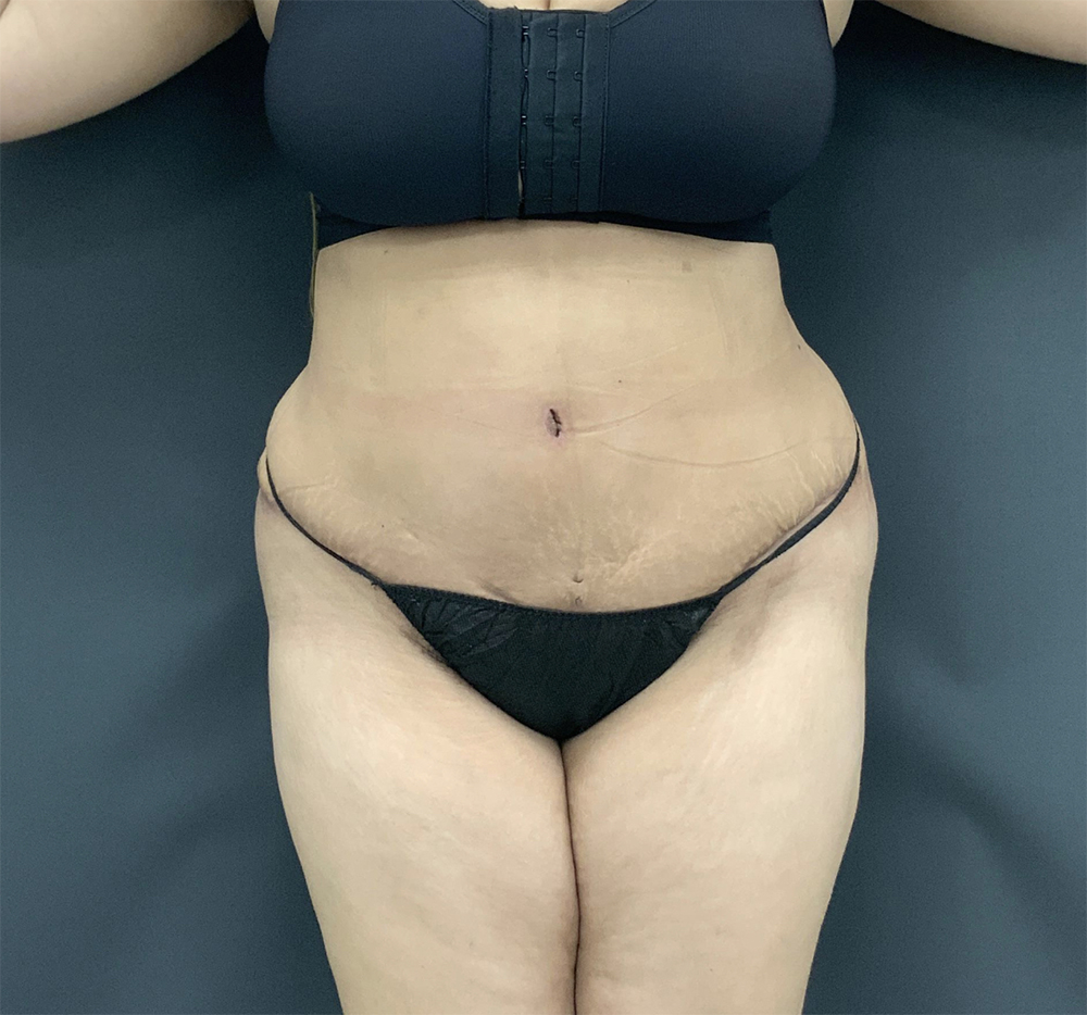 Tummy Tuck Before and After Pictures Washington, DC