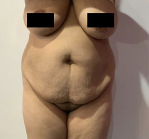 Tummy Tuck Before and After Pictures Washington, DC