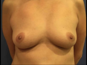 Breast Augmentation Before and After Pictures Washington, DC