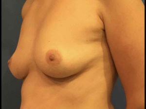 Breast Augmentation Before and After Pictures Washington, DC