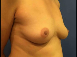 Breast Augmentation Before and After Pictures Washington, DC