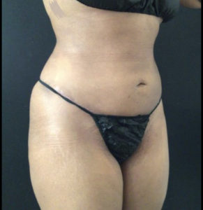 Liposuction Before and After Pictures Washington, DC