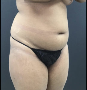 Liposuction Before and After Pictures Washington, DC