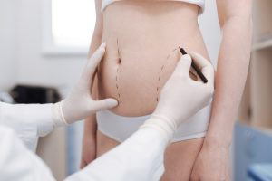 Liposuction Specialist