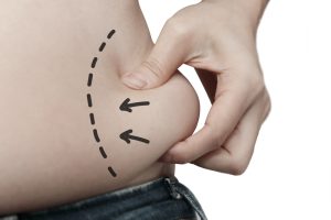 Choosing a Liposuction Specialist in DC: 5 Tips to Find the Best!