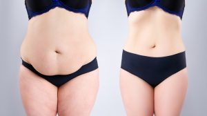 How Much Is Liposuction in McLean