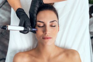 PRP with Microneedling