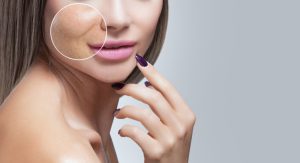 Best Resurfacing Laser Treatments in Vienna