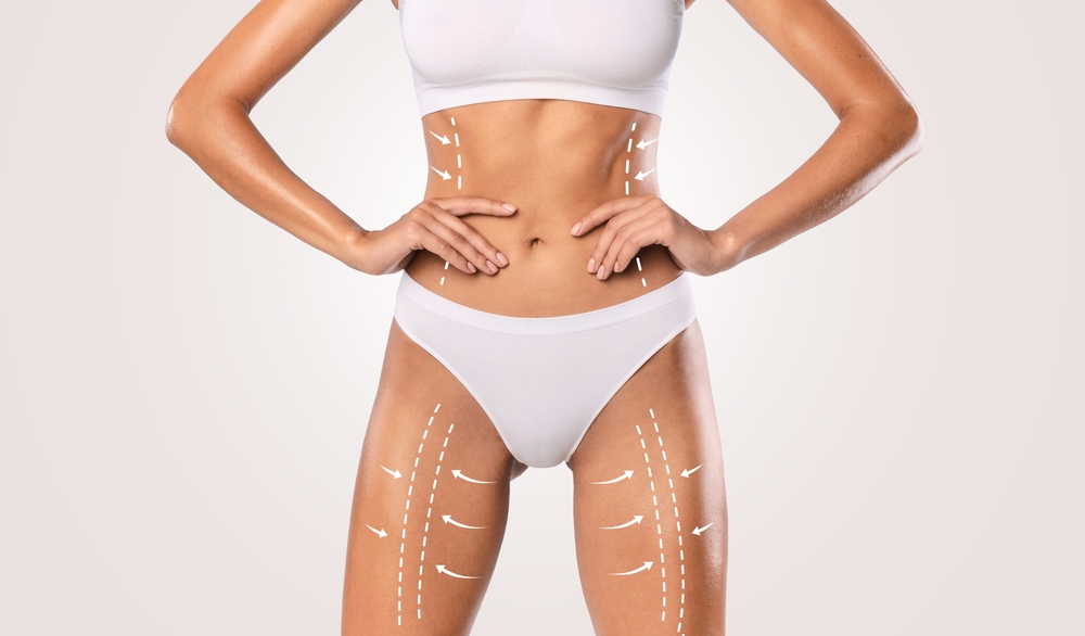 Seattle Liposuction Abdomen & Waist