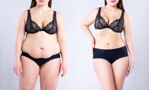 Want the Best Liposuction Results in Fairfax Virginia