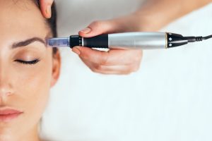 How Long Does Microneedling Last?