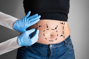 Best Liposuction Results in Ashburn Virginia