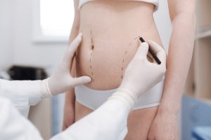 Best Liposuction Surgeon in Fairfax, Virginia