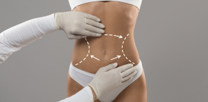 Liposuction Cost in Springfield