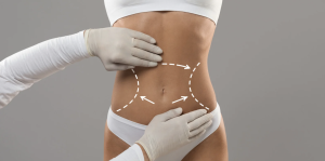 Best Liposuction Surgery Results in McLean