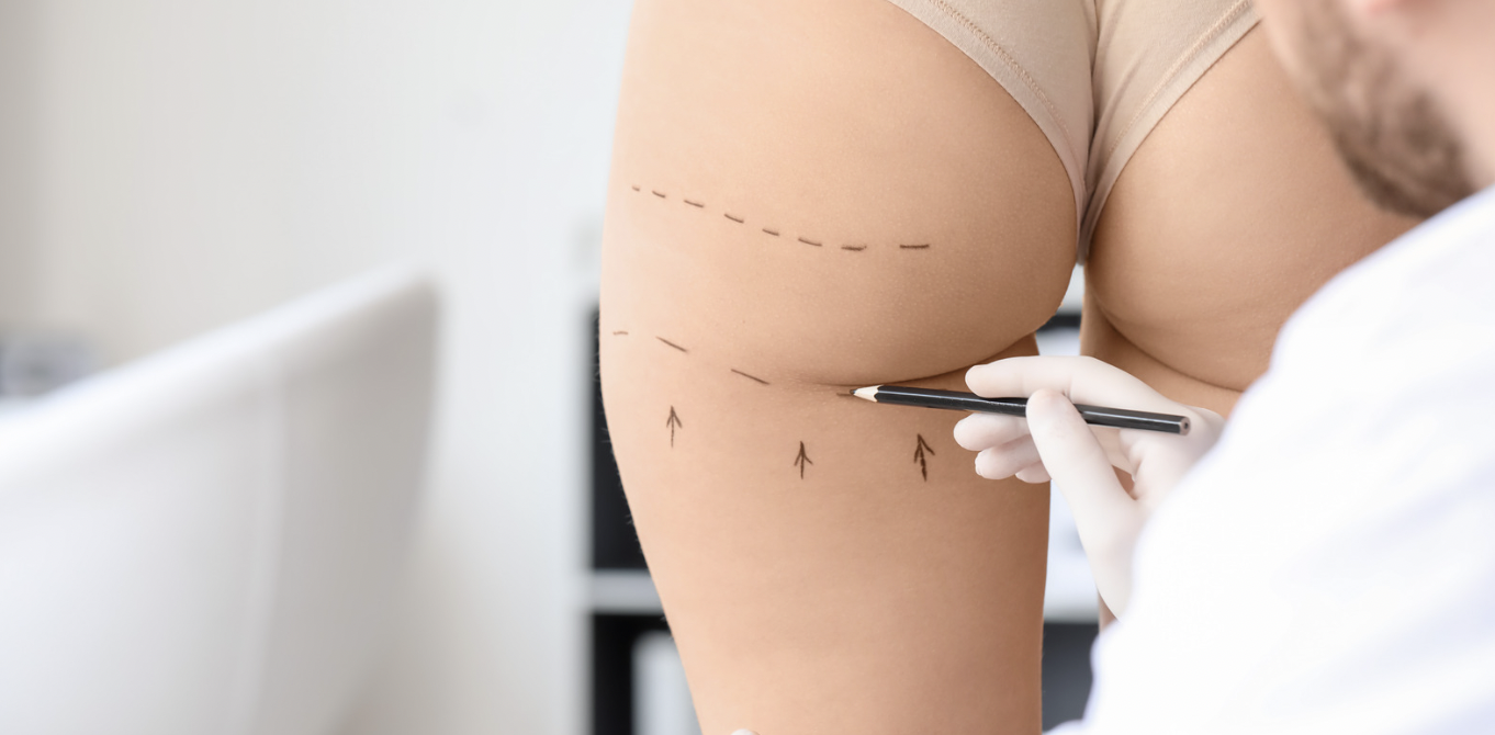 Best Liposuction Surgeon in Reston