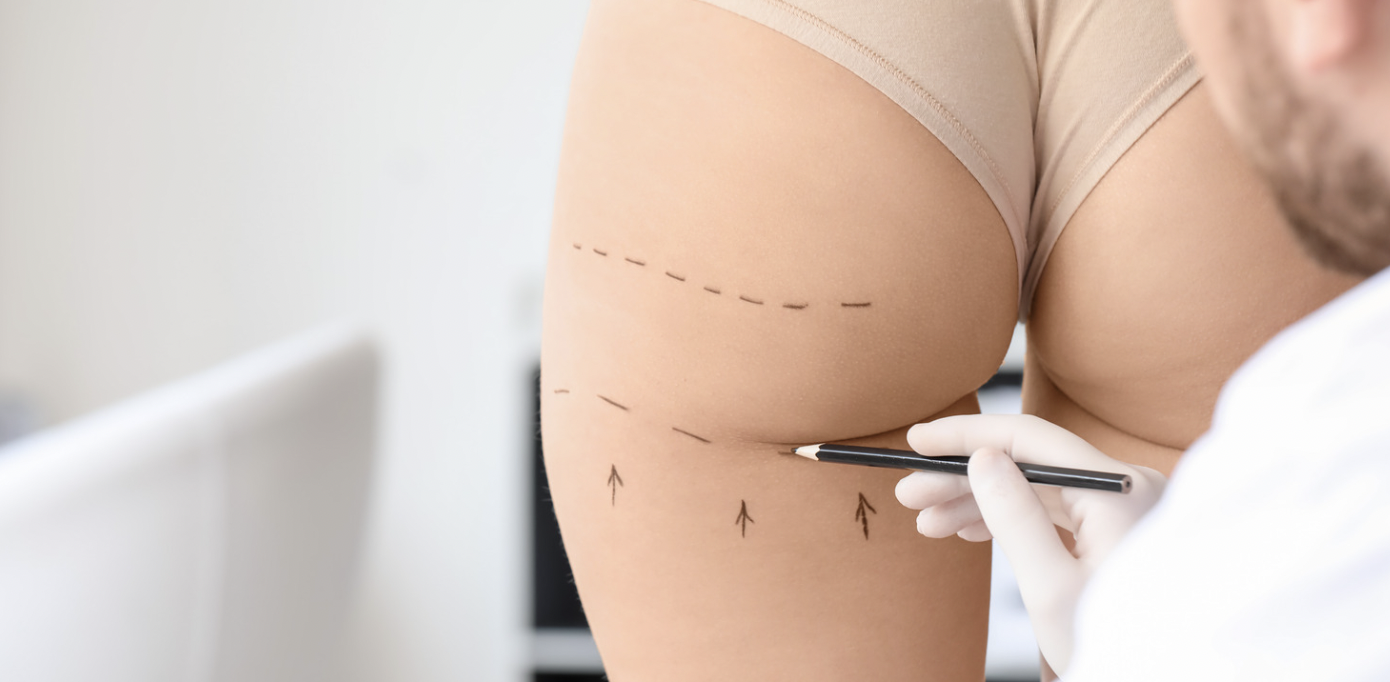 Best Liposuction Results