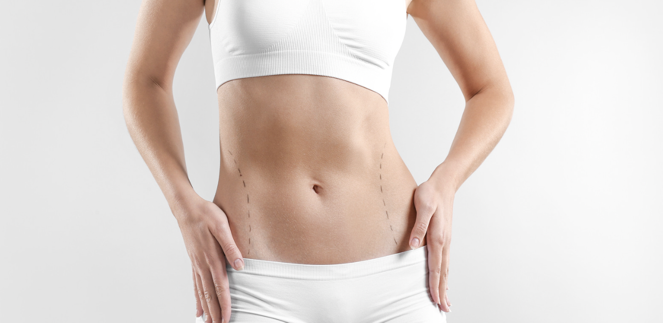 lipo 360 washington d.c. 360 Liposuction in Washington, DC main image 0