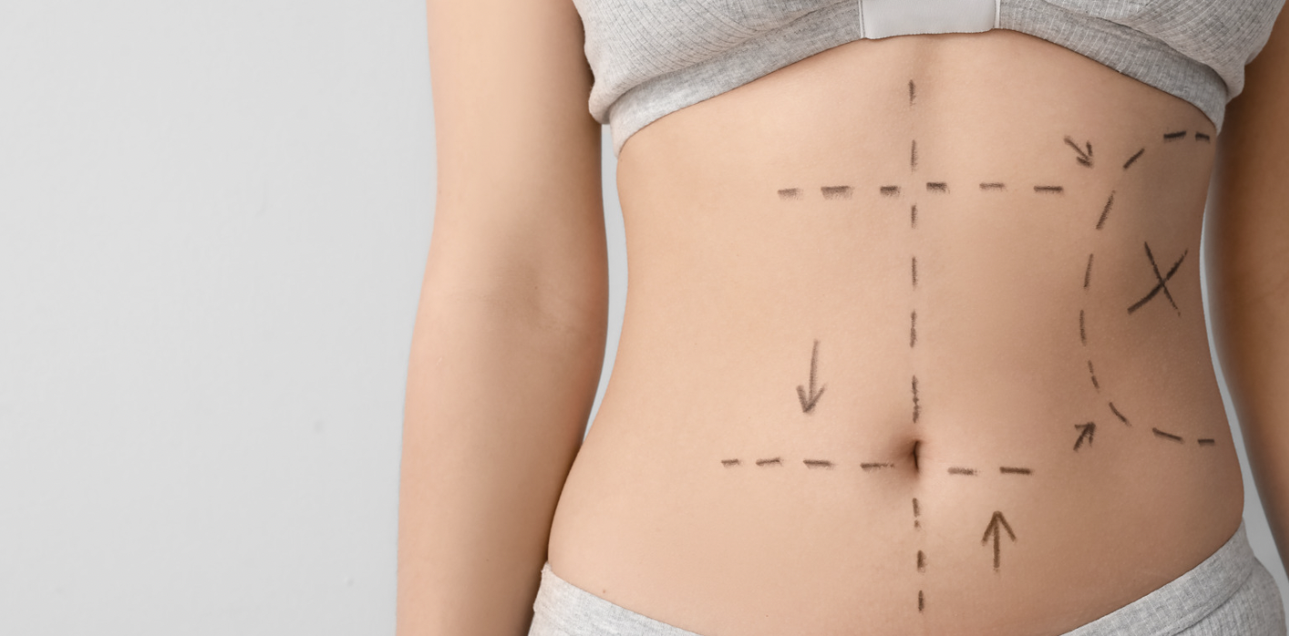 Affordable Liposuction Clinic in Arlington